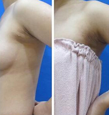副乳吸脂手术多少钱