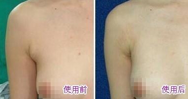 副乳吸脂好不好