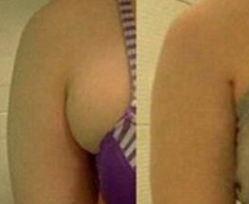 副乳吸脂术后注意事项
