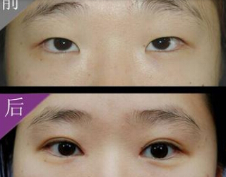 有近视能割双眼皮吗