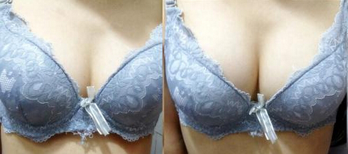 乳房再造术需要多少钱