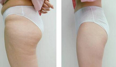 大腿抽脂塑形有没后遗症