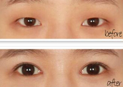 什么样的方法适合男生割双眼皮