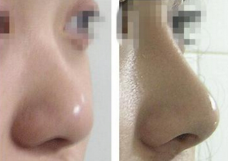 现在最自然最安全的隆鼻是哪种