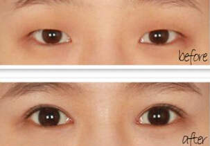 割双眼皮什么季节最好