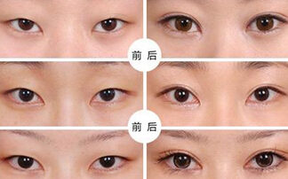 提眉手术后会留疤吗