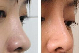 固体硅胶是假体隆鼻常用材料吗