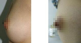 乳头缩小术前后的注意事项