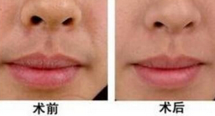 怎样去除胡须有效呢