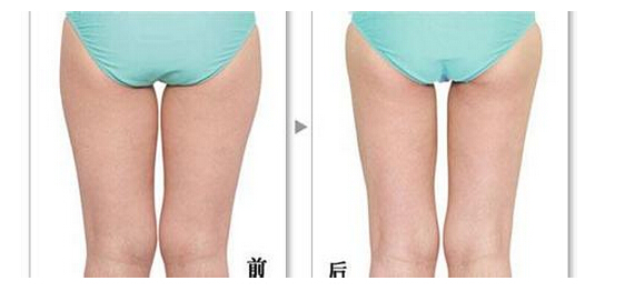 吸脂瘦腿