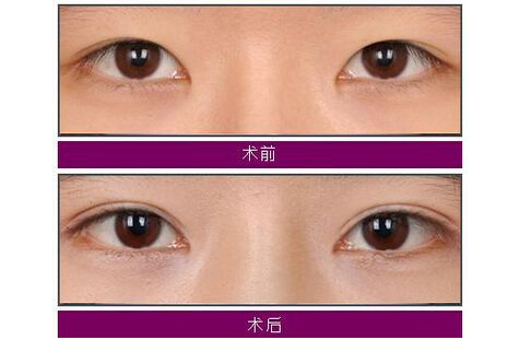 埋线双眼皮