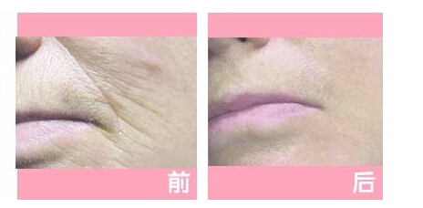 射频除皱
