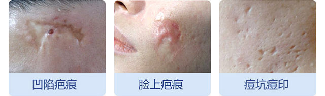 疤痕修复_成都美容整形医院